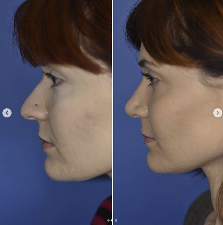 nose tip reduction surgery